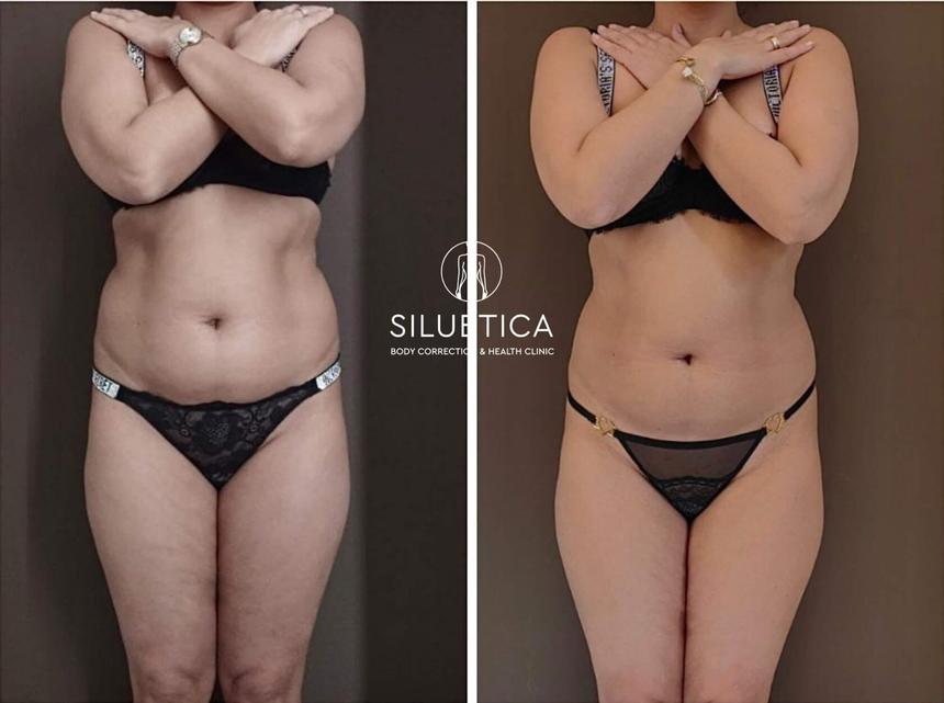 До и после: живот и бока, по 1 сеансу